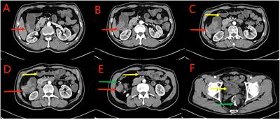 A watch-and-wait approach for metachronous multiple colon cancer following neoadjuvant immunotherapy: a case report